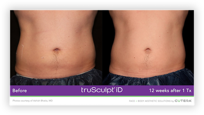 truSculpt® iD Before After 1